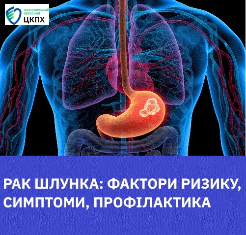Рак шлунка: симптоми, фактори ризику, профілактика