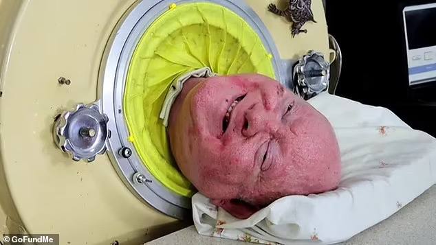 У віці 78 років помер чоловік, який прожив у «залізних легенях» 70 років