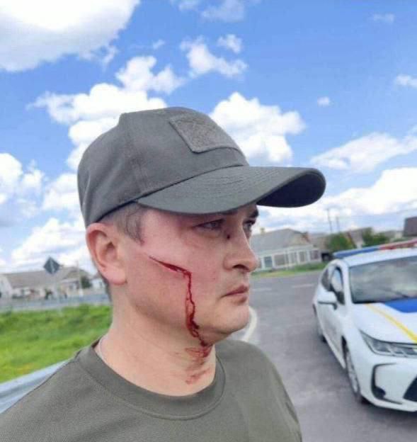 На Волині військовий ТЦК, поранений під час перевірки документів, вимагає 50 тис. грн моральної компенсації